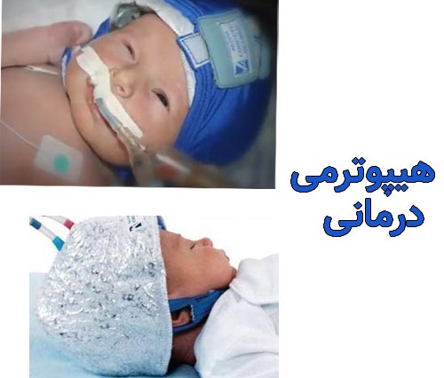هیپوترمی درمانی برای نرسیدن اکسیژن به مغز نوزاد